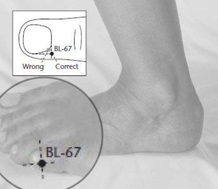 Меридиана Мочевого пузыря, точка BL-67